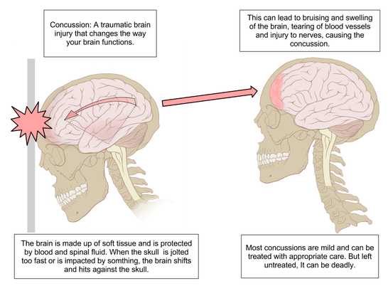 VivaHealthyLife's tweet image. How to treat a brain injury

Treatment for post-concussion syndrome focuses on providing symptom relief to help a person manage the condition. Rest is one of the most important components...
Read more: philaholisticclinic.com/treatment-for-…
#brainconcussion 
#braininjury 
#holistic