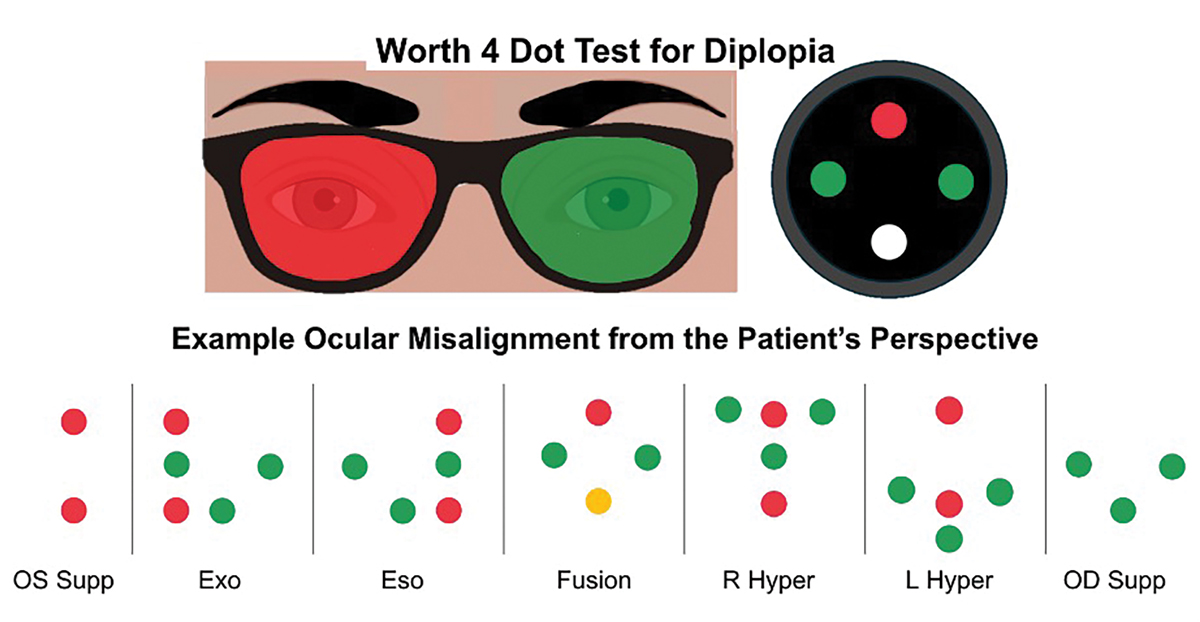 revoptom's tweet image. While binocular diplopia is concerning for a neurologic process, monocular diplopia more likely indicates an issue with ocular media or refractive status.

Read here: revieweducationgroup.com/ce/differentia…

#reviewofoptometry #optometry #optometrist #RO2025inreview