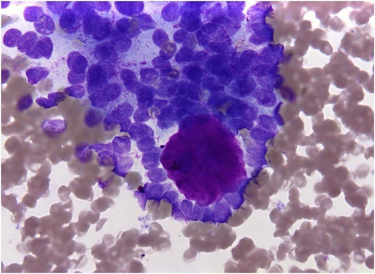New and #OpenAccess | Fine-needle aspiration cytology reduces the frequency of surgeries for malignant salivary gland tumors

acsjournals.onlinelibrary.wiley.com/doi/10.1002/cn…

#CytoPath <a href="/DrMedShabli/">Sami Shabli</a> <a href="/AlexQuaas/">Alexander Quaas</a>