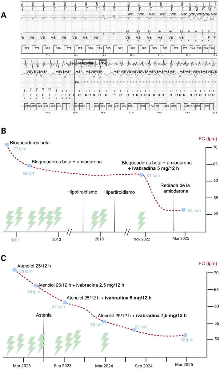 Ivabradina para la prevención de la fibrilación ventricular desencadenada por taquicardia sinusal en la miocardiopatía hipertrófica #REC #Aheadofprint <a href="/Eva_CabreraB/">Eva Cabrera Borrego</a> @Franbermudz <a href="/MaciasRuiz_R/">Rosa Macías Ruiz</a> revespcardiol.org/es-ivabradina-…