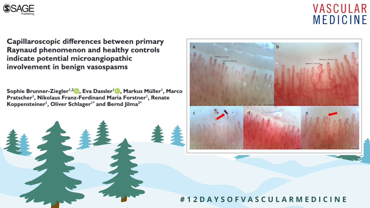 Brunner-Ziegler et al: "Capillaroscopic differences between primary #Raynaud phenomenon and healthy controls indicate potential microangiopathic involvement in benign vasospasms" 
doi.org/10.1177/135886… 

Day 11 #12DaysofVascularMedicine #Vasospasm