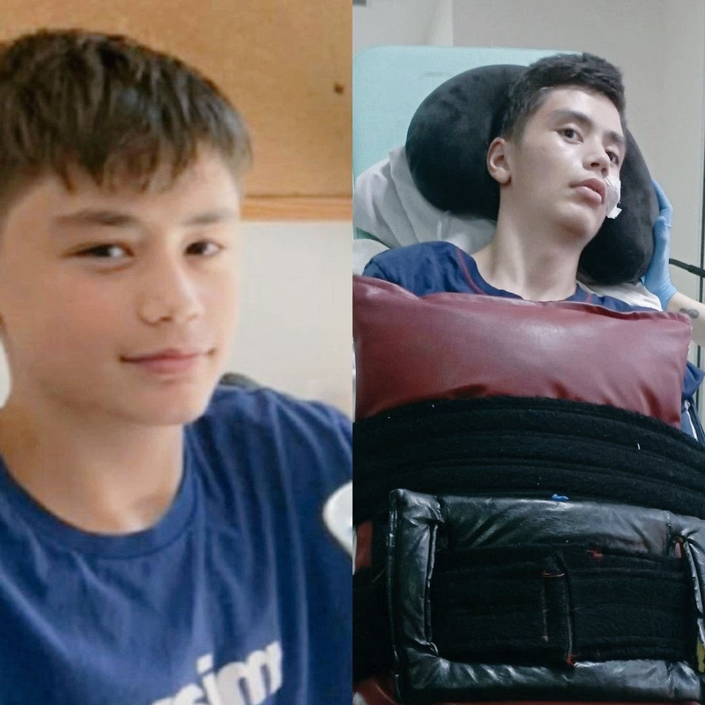 Soldaki fotoğraf; hayalleri olan, gülen, okuluna giden Murat Duha. Sağdaki ise sadece 'yanlışlıkla ayağa basma' bahanesiyle darp edildikten sonraki hali... Bir çocuğun hayatını bu kadar kolay karartamazsınız. Sessiz kalmayın, Murat’ın sesi olun! 📢 #muratduhayıldız #Adalet"