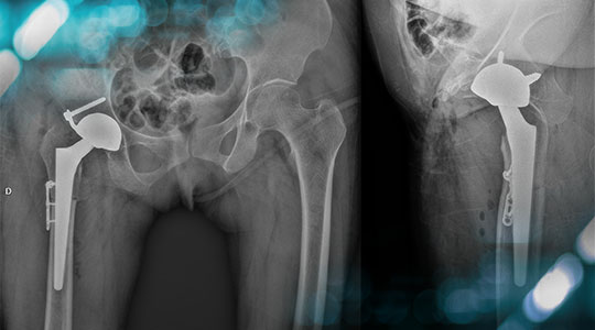 PC_Orthopedics's tweet image. 🏥 PART 2 –  Severe #hip pain, limb shortening, and altered gait in a 60-year-old woman raise the question of advanced hip dysplasia and its optimal management.
 Explore the final diagnostic classification and the surgical strategy selected. 👉🏼 brnw.ch/21wYz51
#PCO