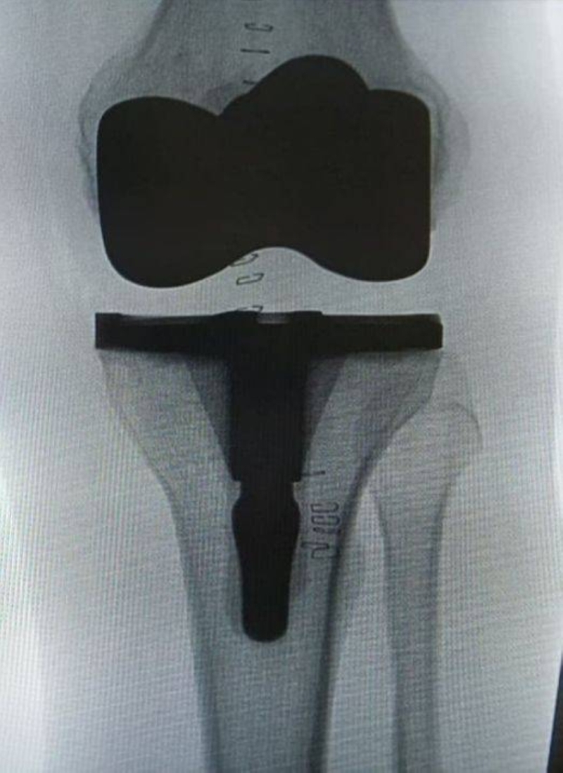 فريق طبي بمستشفى الإيمان العام يُجري عملية تلبيس مفصل الركبة بنجاح #تجمع_الرياض_الصحي_الأول 