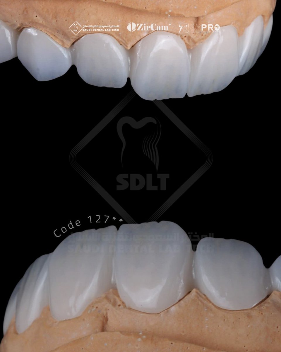 saudi_lab's tweet photo. إحدى منتجات الزيركام في المختبر السعودي لتقنية الأسنان التي تجمع بين الجمالية والقوة، وتُعتمد ضمن التصنيف الوظيفي الجمالي لما تقدّمه من تناسق ودقة.
المنتج Code **127 يبرز بتصميم متقن وإنهاء عالي يمنح الطبيب والمريض نتيجة موثوقة ومظهر طبيعي.

#dental #Zircam https://t.co/BANBmBtGRq