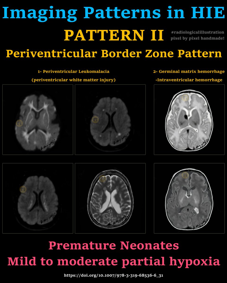 drharunyildiz's tweet image. Imaging Patterns in HIE 

♦️ PATTERN II 

Periventricular Border Zone Pattern
1- Periventricular Leukomalacia
2- Germinal matrix hemorrhage/Intraventricular hemorrhage

✔️ Premature Neonates
✔️ Mild to moderate partial hypoxia

doi.org/10.1007/978-3-…