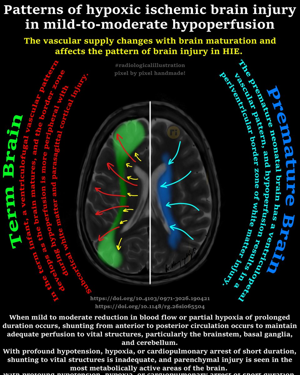 drharunyildiz's tweet image. Imaging Patterns in HIE 

♦️ PATTERN II 

Periventricular Border Zone Pattern
1- Periventricular Leukomalacia
2- Germinal matrix hemorrhage/Intraventricular hemorrhage

✔️ Premature Neonates
✔️ Mild to moderate partial hypoxia

doi.org/10.1007/978-3-…