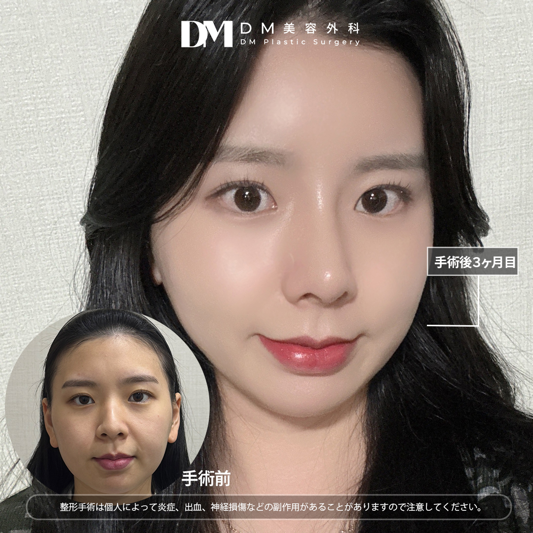 糸リフト失敗！？糸リフトの名医が失敗しやすい輪郭と糸の入れ方を徹底解説！ - 秋葉原院, image size:1080x1080