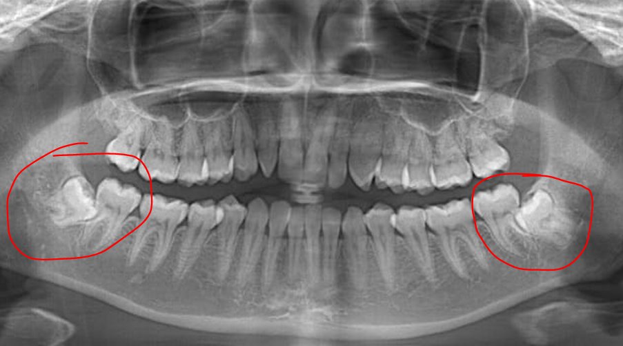 Siapanih yg gigi bungsunya miring" gini? boleh ceritain dong gimana rasanya?