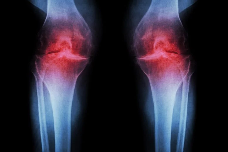 Longevity update: Anti-Aging Injection Regrows Knee Cartilage and Prevents Arthritis

Scientists at Stanford Medicine found that blocking an age-linked protein (15-PGDH) can regrow knee cartilage, reverse joint damage in older animals, and prevent arthritis after ACL-like
