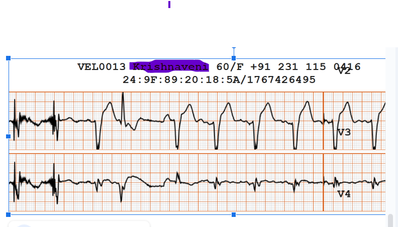 sucarditek's tweet photo. an interesting patient with a LOT CRT - what is triggering the arrhythmia ? the rest of the tracing ? https://t.co/KFTqrRYw6D