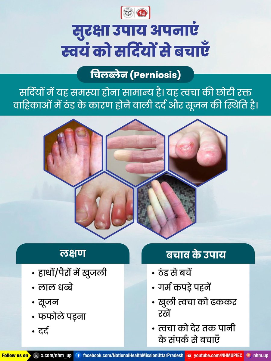 ❄️ सर्दियों में उंगलियों की सूजन और खुजली को हल्के में न लें, बचाव के उपाय अपनाएं।🖐️💙

Chilblains | Winter Skin Care | Cold Weather Safety

#Chilblains #WinterHealth #NHMUP