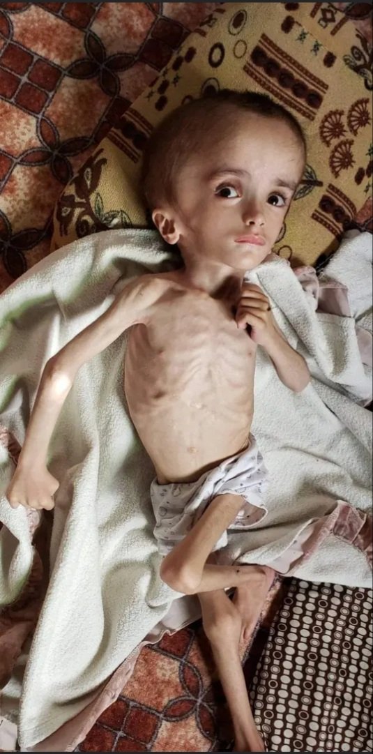 Simon99332663's tweet photo. @elonmusk A sick child suffering from hydrocephalus since childhood. His family's financial situation is unstable, and he needs $150 worth of monthly treatment. The child needs sponsorship from any organization. To contact the family, please call +967777996816 https://t.co/if7FRoRoHK