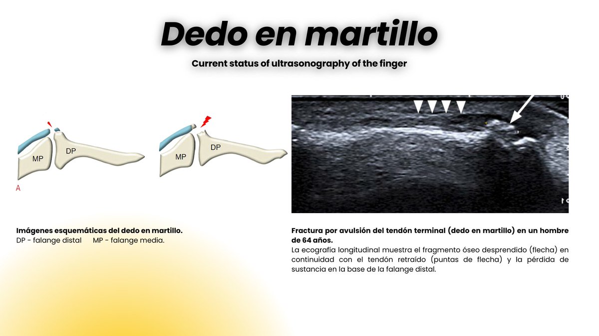 Dedo en martillo -
Artículo - Current status of ultrasonography of the finger - Seun Ah Lee et al.

pmc.ncbi.nlm.nih.gov/articles/PMC48…