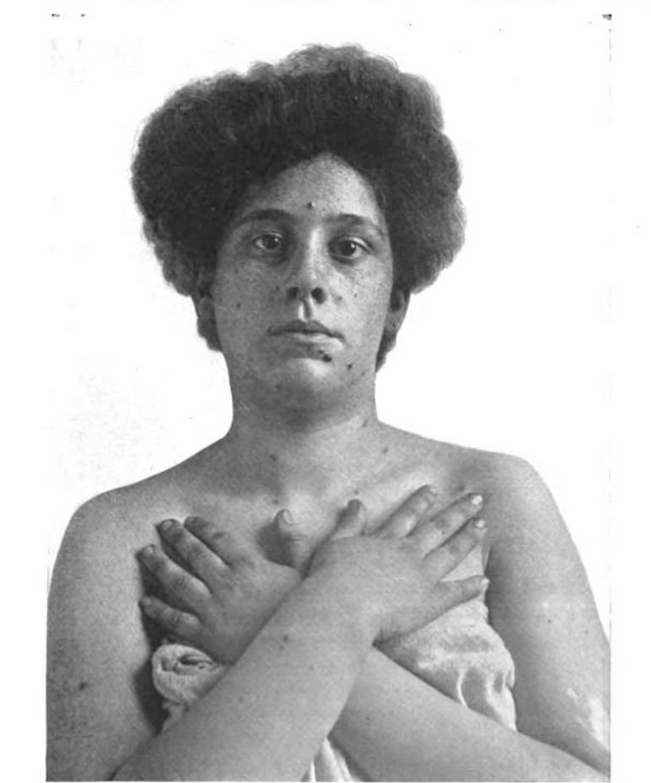 RBystrianyk's tweet image. A curious fact about smallpox: the images we typically almost always see are severe, but by the early 20th century, most cases were actually mild. People often emphasize the dramatic over the commonplace. History isn’t what you might think.
[“Small-pox—extremely mild; lesions…