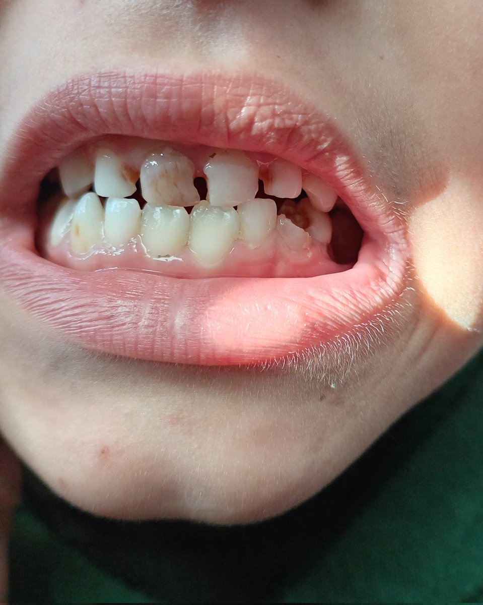 DalulainGaza's tweet image. 💔My little daughter is losing weight rapidly due to severe dental pain. All his teeth are badly damaged, and we cannot afford his treatm
🙏
chuffed.org/project/138194…