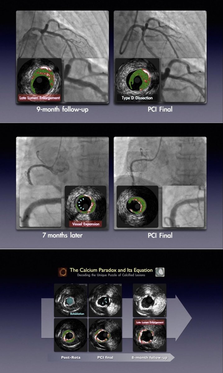 stefan_harb's tweet photo. @realarainmd @ziadalinyc @saraceciliamtz @Hragy @PurumittalDr @SVRaoMD @jedicath @SarahFairley7 @CtoEuro @ron_waksman @evandrofilhobr @ttabishNano Have you already seen the dissection cases
Yoshihisa Shimada showed us 
at #DCBClub Berlin?
His talk is on YouTube.
He explained vessel growth depends on cutting into healthy segments that would heal with plenty of hyperplasia if not inhibited by drug.
Include recent VSMC review https://t.co/VR66u2Xym5