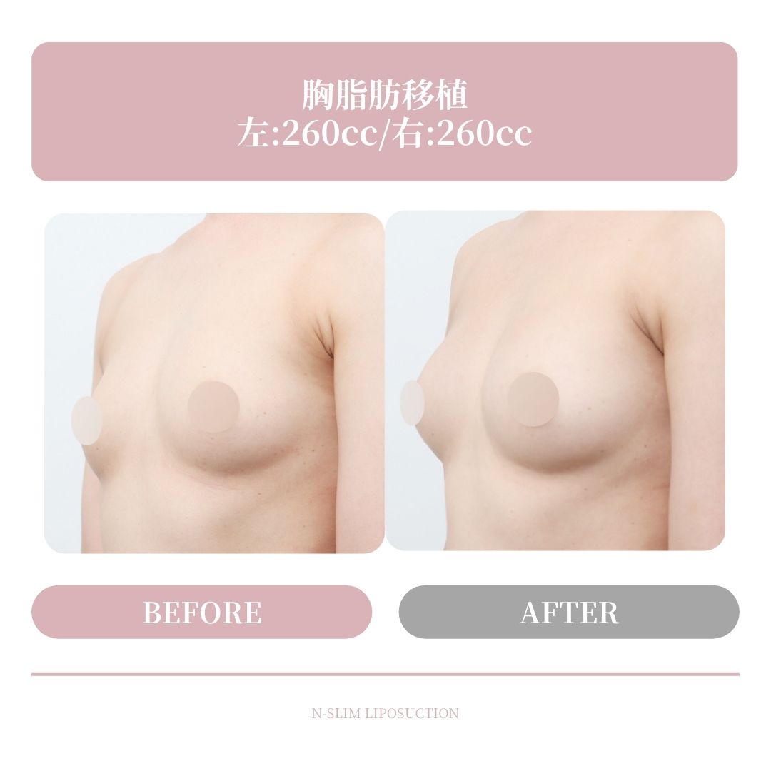 足りないボリュームは、ナチュラルにup🩷

☘️お問い合わせ
(日本語対応可能)
📲82-10-6771-4500
LINE ID : @nslim

💓日本語通訳が常駐しています🥰
診療時間内に対応します。

☘️診療時間案内
火曜日~金曜日 10時~19時
土曜日 9時~16時
毎週日曜日、月曜日、祝日休診

❤YouTube : @Dr_nslim