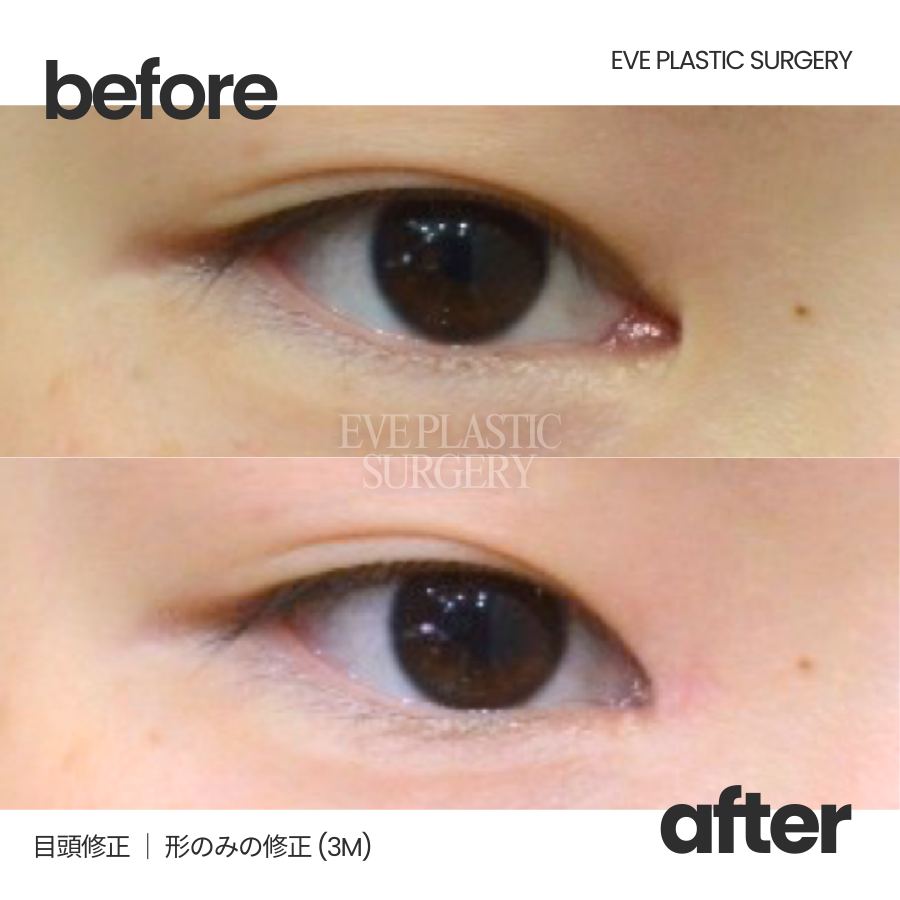 EvePlastic's tweet photo. 【目頭切開、やりすぎた…と感じている方へ👁】
✔ 赤い肉が目立つ
✔ 目が乾く・ゴロゴロする
✔ きつい印象になった
それ、目頭切開のやりすぎかもしれません。

目頭修正手術で
不自然さのない、やさしく自然な目元へ。
見た目だけでなく、
目の乾燥感が軽減した方も多数。

日本にはない🇰🇷
ジョン先生の独自の修正方法
 → 副作用が少なく
 → あと戻りが起こりにくい✨

修正歴20年。
再手術・修正専門だからできる選択肢があります🌿
📷 写真カウンセリングOK
🗓 当日手術枠のご案内も可能

📩公式LINEから受付中 ｜ https://t.co/qb3YISiTw9 

#イブ整形外科 #目頭修正 #目頭切開傷跡 #目頭切開修正 #傷跡修正 #目頭切開失敗 #目元整形トラブル修正 #目元整形 #涙丘露出 #整形修正 #整形失敗修正 #自然な目元 #韓国美容整形 #渡韓整形サポート #無料カウンセリング #目元コンプレックス #目元の悩み #整形再手術 #目元美人 #二重整形 #ナチュラル目元 #美容整形 #韓国整形 #目元形成 #目頭切開
