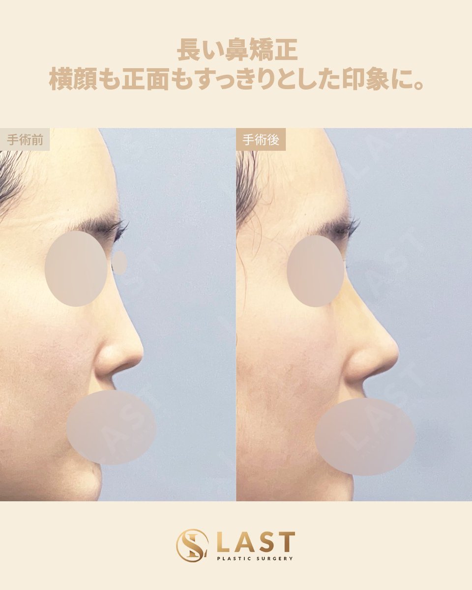 鼻形成術　裁断済み ✨鼻整形症例紹介｜ラスト美容外科 ✨ 📍執刀医：チェ・ジェホ代表院長
