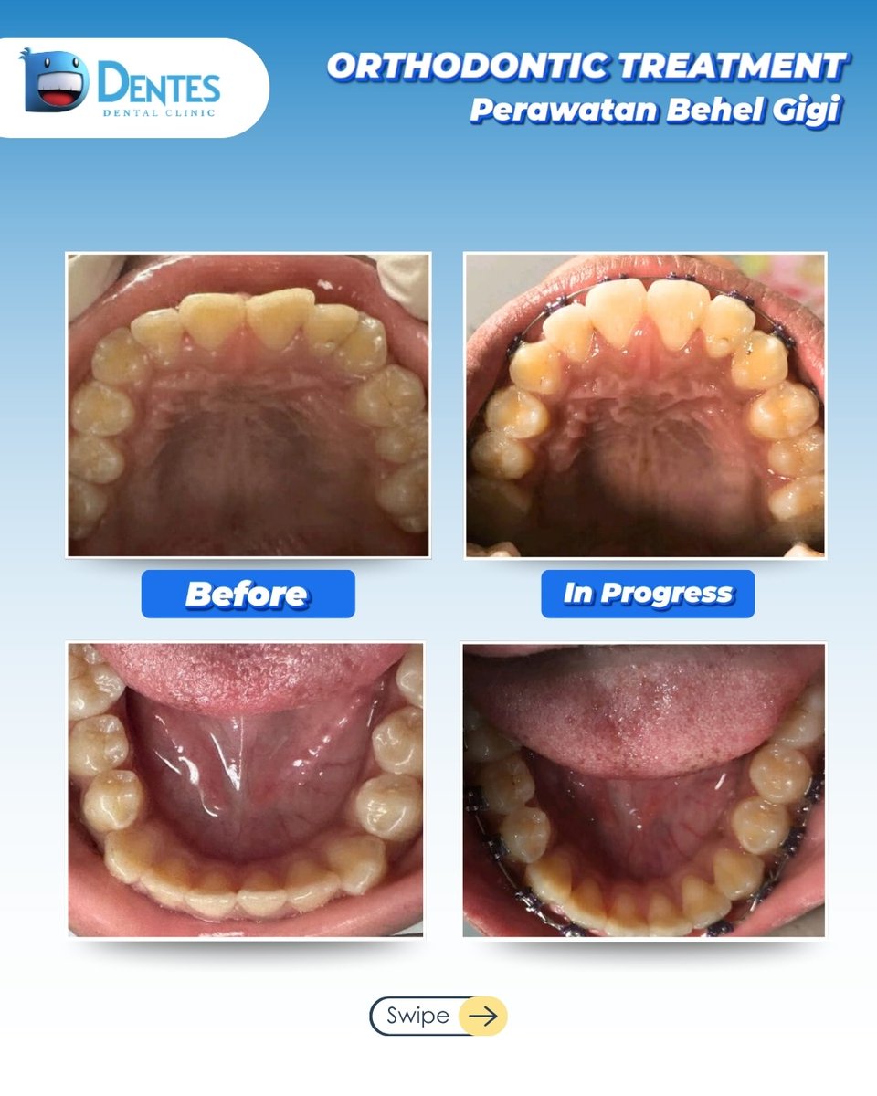 Progress perawatan behel gigi, Menurut kalian gimana hasilnya?