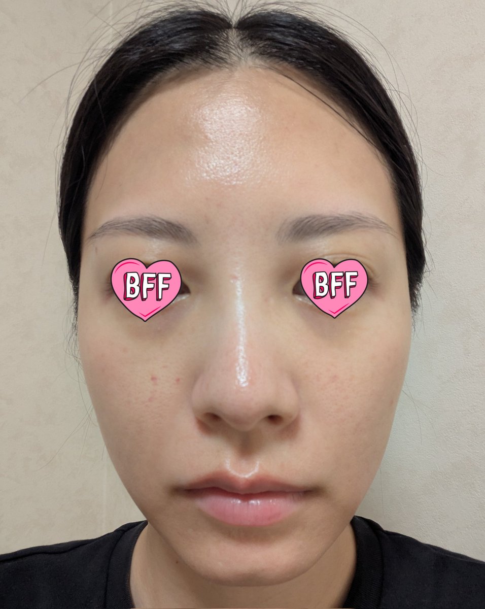 ジュベルックを打って2日後の朝☀
頬の内出血は明日も消えてないだろうな。コンシーラーで隠れるかな😅