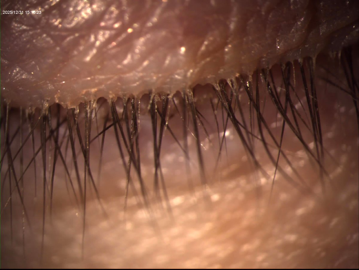 sokoleyecare's tweet photo. Itchy eyelids ≠ allergies 👀

Demodex mites can cause redness, irritation, and stubborn eye discomfort—and you can’t fully treat them at home.
Professional evaluation = real relief.

#EyeCare #EyeHealth #Demodex https://t.co/MePDtF7yb9