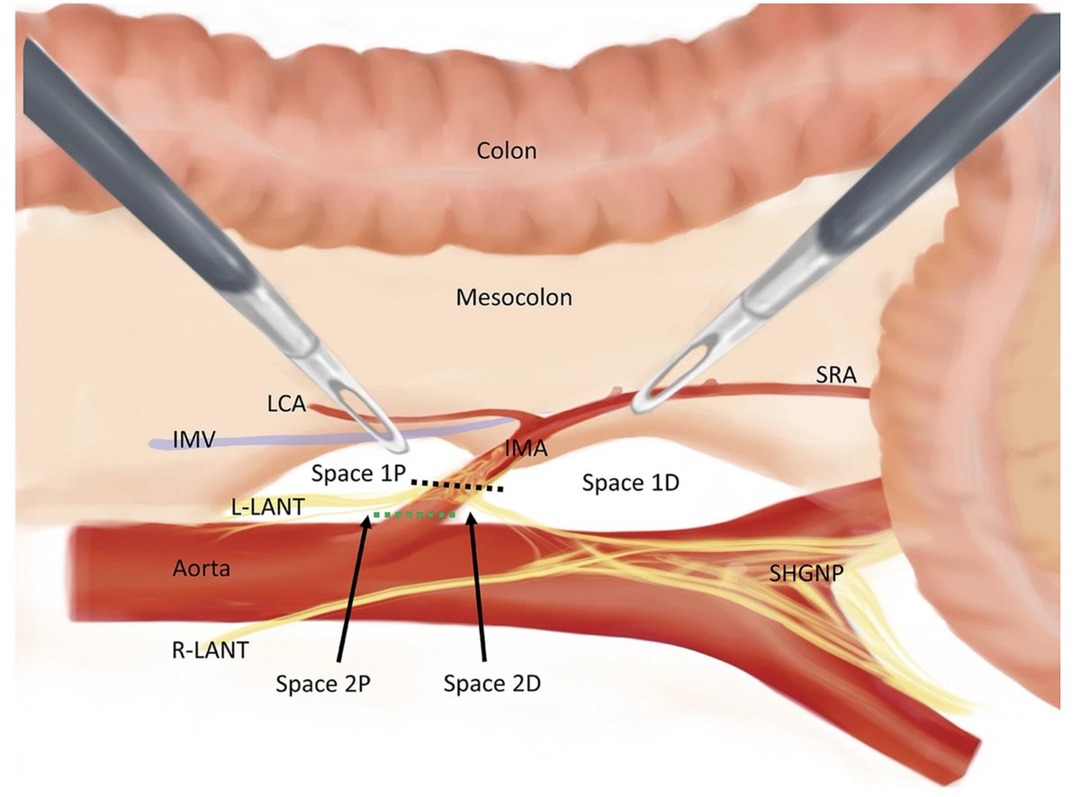 AnnSurgOncol's tweet image. January Issue: Two Levels of High Ligation of the Inferior Mesenteric Artery Based on Three Anatomical Fasciae for #ColorectalCancer

rdcu.be/eXkRp

@DrPandalai
@SyedAAhmad5
@SocSurgOnc