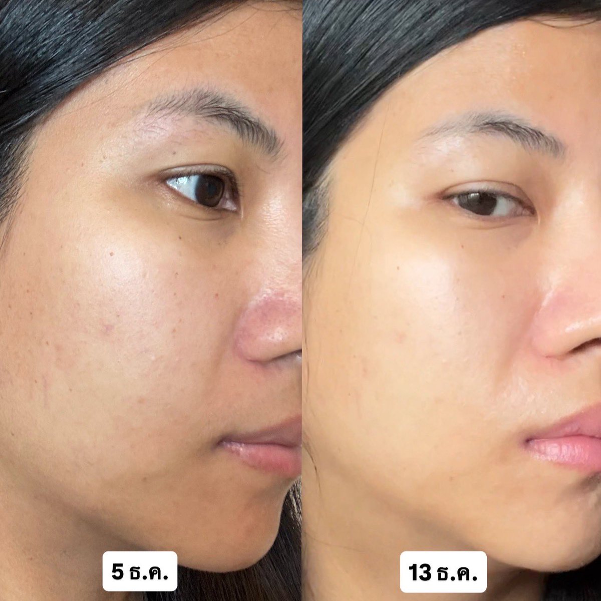 Sawarinni's tweet photo. ช่วงนี้นอนน้อยสิวบุกแล้วทิ้งรอยสิวฉ่ำมาก เห็นสาวๆผิวใสๆแชร์ NIVEA Skin Glow Serum เยอะมากก พอลองใช้ได้วีคนึงผิวดีขึ้นจริง ผิวใสมากกกก! จุดดำรอยสิวดีขึ้น ที่ผลลัพธ์จึ้งเพราะตัวนี้ใส่ Thiamidol สารไบรท์เทนนิ่งตัวท็อปของนีเวีย เข้าไปจัดการจุดดำถึงต้นตอ พวกรอยดำจางไว ผิวหน้าโกลว์แบบ���ู้กล้องเลย เนื้อซึมไว บางเบา สบายผิว ราคาเป็นมิตรด้วย พุ่งตัวไป 7-11 เลย