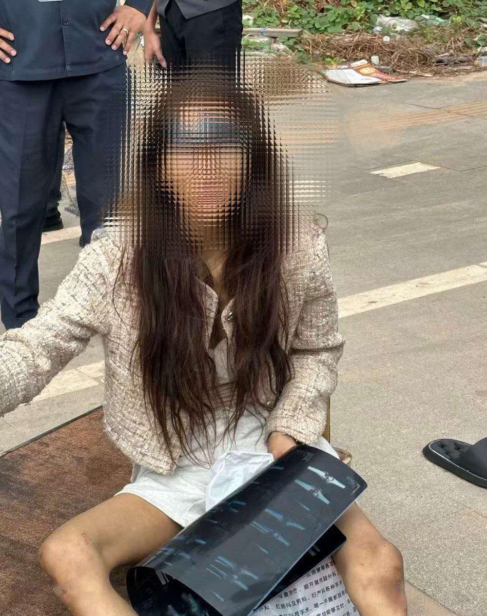 jacobincambodia's tweet photo. Promised a “high-paying job,” a Chinese woman instead ended up homeless, malnourished, and abandoned on the streets of Sihanoukville.

According to the Chinese Embassy in Cambodia, the woman, surnamed Wu, came to Cambodia after being recruited with assurances of lucrative work. She was later found in extremely poor physical condition and located at a hospital in Sihanoukville after the case spread widely on Chinese social media.

Embassy staff coordinated with Cambodian authorities and arranged her transfer to Sihanoukville Tongji Hospital, where doctors reported multiple infections, severe malnutrition, and serious physical decline. Her condition has since stabilized and treatment continues.

Chinese media report she was abandoned near a hotel in Sihanoukville on December 26, 2025. Photos circulating online showed her holding a CT scan and appearing disoriented. Passport information identified her as being from Fujian Province. Her father confirmed the identity, said the family lost contact with her on December 26, and filed a missing person report in China.

The embassy stated her family has been contacted and arrangements are underway for her return. It again warned that overseas “high-paying job” offers are frequently tied to scam operations and other criminal industries, where victims face abandonment, abuse, and life-threatening neglect.