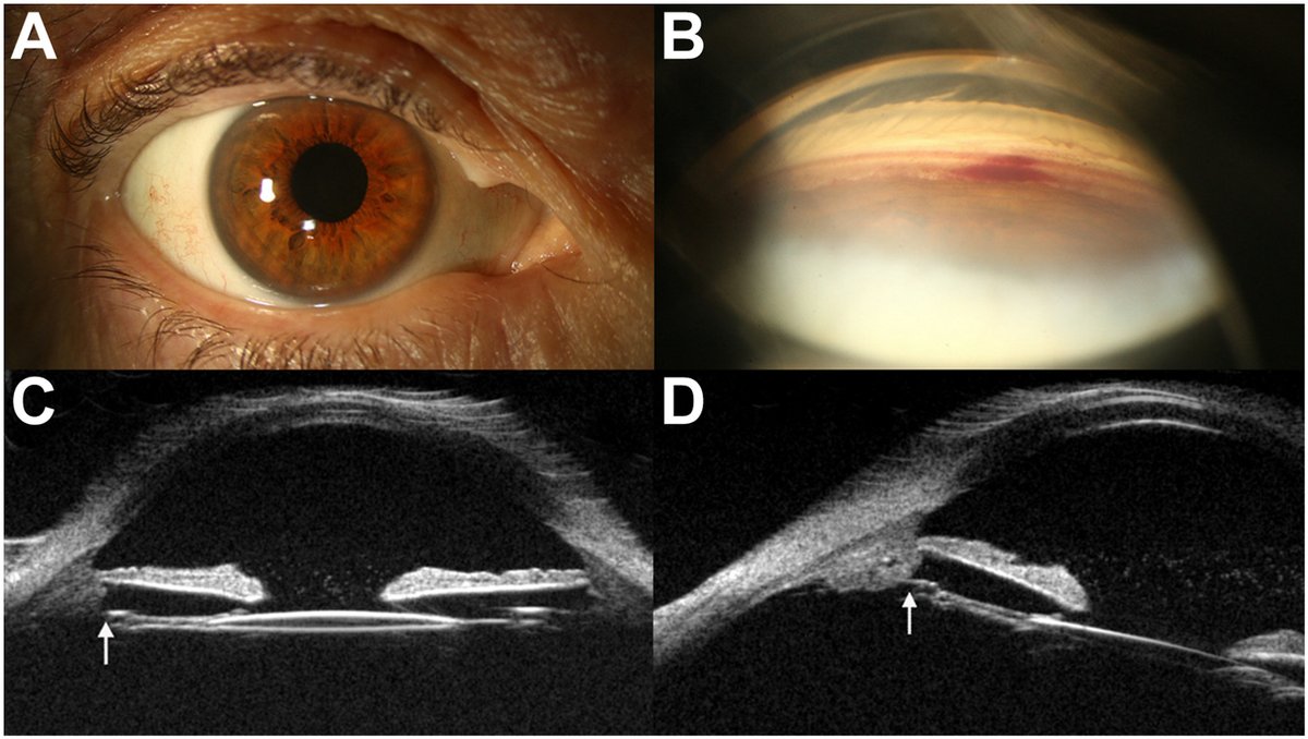 AAOjournal's tweet image. A 75-year-old physician presented with recurrent episodes of painless and “foggy” vision in the right eye (OD) lasting 3 hours. He was investigated for amaurosis and began dual anti-platelet therapy. Vision OD was 20/25, intraocular pressure was 43 mmHg, and the anterior chamber…