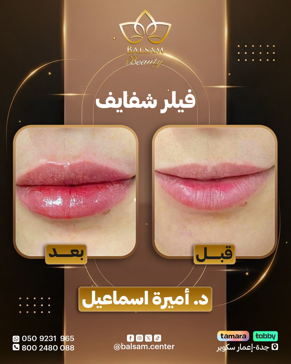 لمسات فيلر الشفايف تزيد ثقتك في نفسك و تخلي لابتسامتك طلة لا تفوت
تسلم يدك يا د. أميرة اسماعيل

احجزي موعدك اليوم!
واتساب 0509231965
اتصال 8002480088
جدة – إعمار سكوير