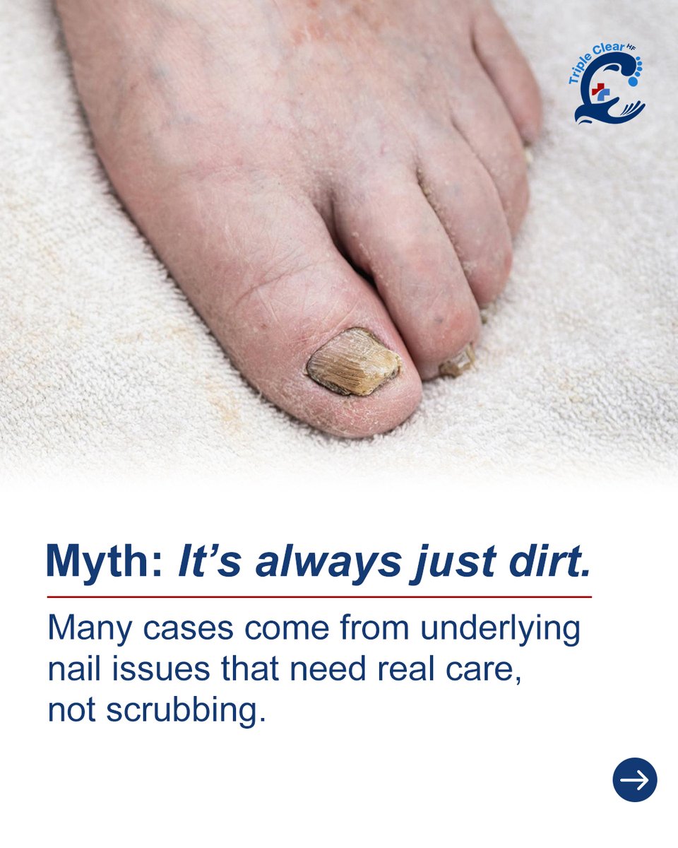 TripleClearHF's tweet image. Think nail discoloration is just dirt? Many cases need real care.

Triple Clear HF treats and protects nails naturally.

Start a routine that works.

Buy now at TripleClearHF.com

#HealthyNails #NailCareRoutine #TripleClearHF #NaturalNailCare #NailProtection #FootCare