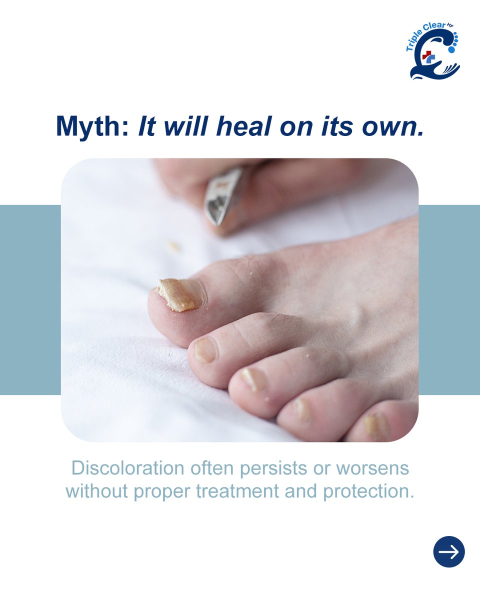 TripleClearHF's tweet image. Think nail discoloration is just dirt? Many cases need real care.

Triple Clear HF treats and protects nails naturally.

Start a routine that works.

Buy now at TripleClearHF.com

#HealthyNails #NailCareRoutine #TripleClearHF #NaturalNailCare #NailProtection #FootCare