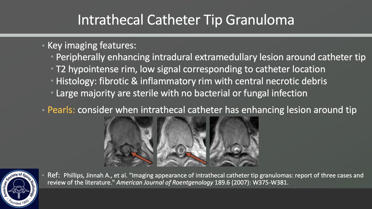 ASSR COTW  

History: Progressive leg weakness, multiple spinal surgeries and chronic pain

#SpineRad #NeuroRad #MedEd #FOAMed #FOAMrad #neuroradiology #radiology