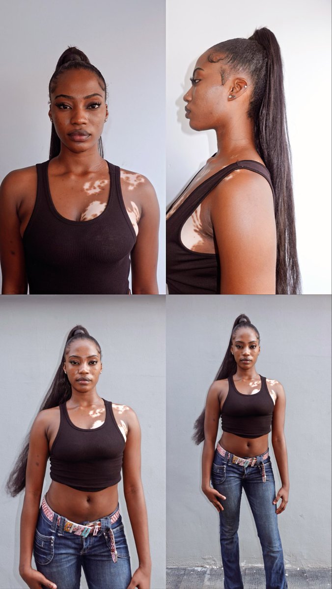 AngelaOgbaji_'s tweet image. Hi, I’m Angela. Height: 5’8”. Model with vitiligo. Digitals attached.