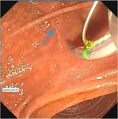 VideoGIE Editor's Choice: "Submucosal injection to facilitate needle-knife sphincterotomy: a novel technique" by Kambiz Kadkhodayan et al. videogie.org/article/S2468-…

#GITwitter

<a href="/KKadkhodayan/">Kambiz Kadkhodayan</a>