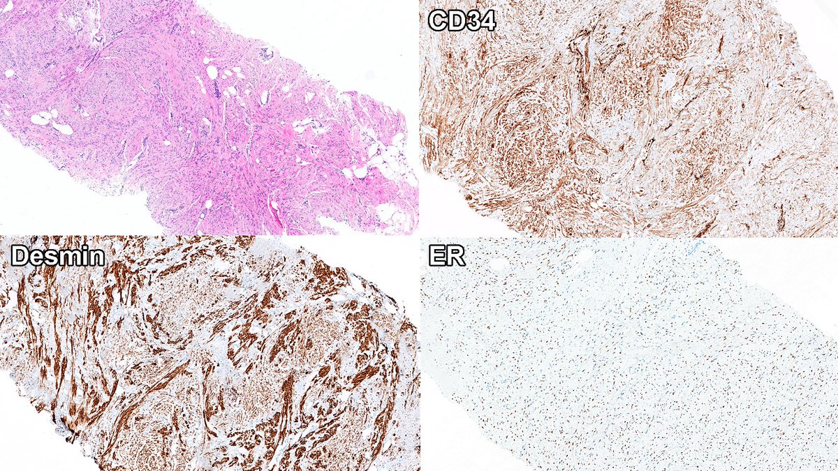 RazaHoda's tweet image. Awesome job!

The answer was myofibroblastoma.

☑️ Bland spindle cells in collagenous stroma
☑️ Devoid of breast glands
☑️ Associated with monoallelic 13q14 loss

IHC provided 👇.

#PathX #PathTwitter #breastpath