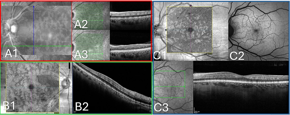 AAOjournal's tweet image. High Yield of Systemic Workup in Patients with Acute Isolated Paracentral Acute Middle Maculopathy
ow.ly/eQlh50XHpjF
#ophthalmology