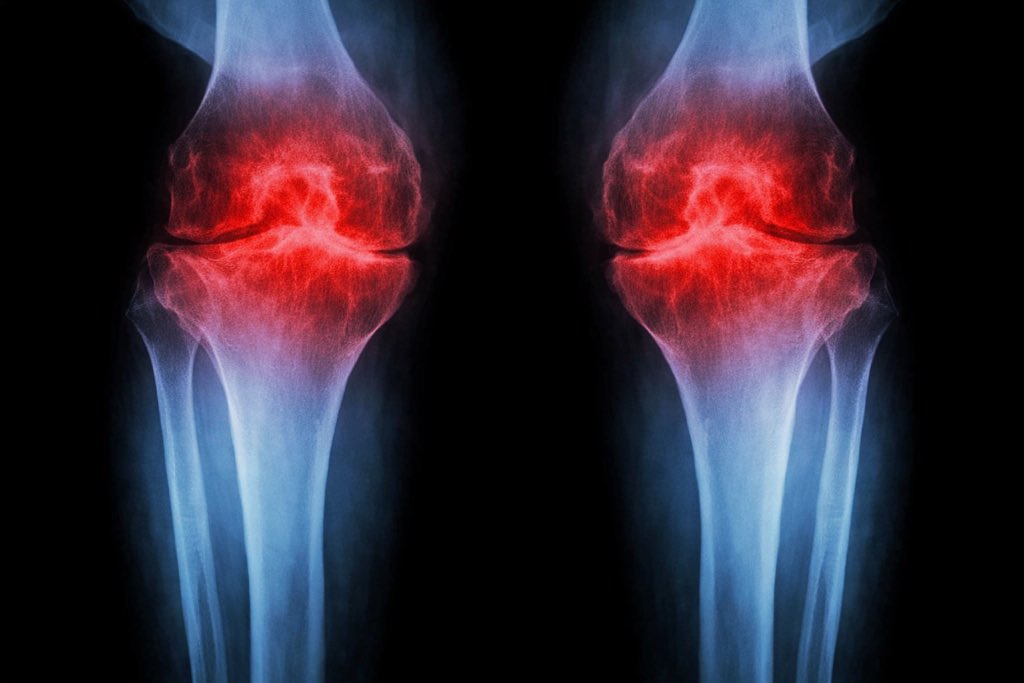 SCIENCE: Anti-Aging Injection Regrows Knee Cartilage and Prevents Arthritis

Researchers at Stanford Medicine report that blocking a protein linked to aging can restore cartilage that naturally wears away in the knees of older mice. In the study, the injectable treatment not only