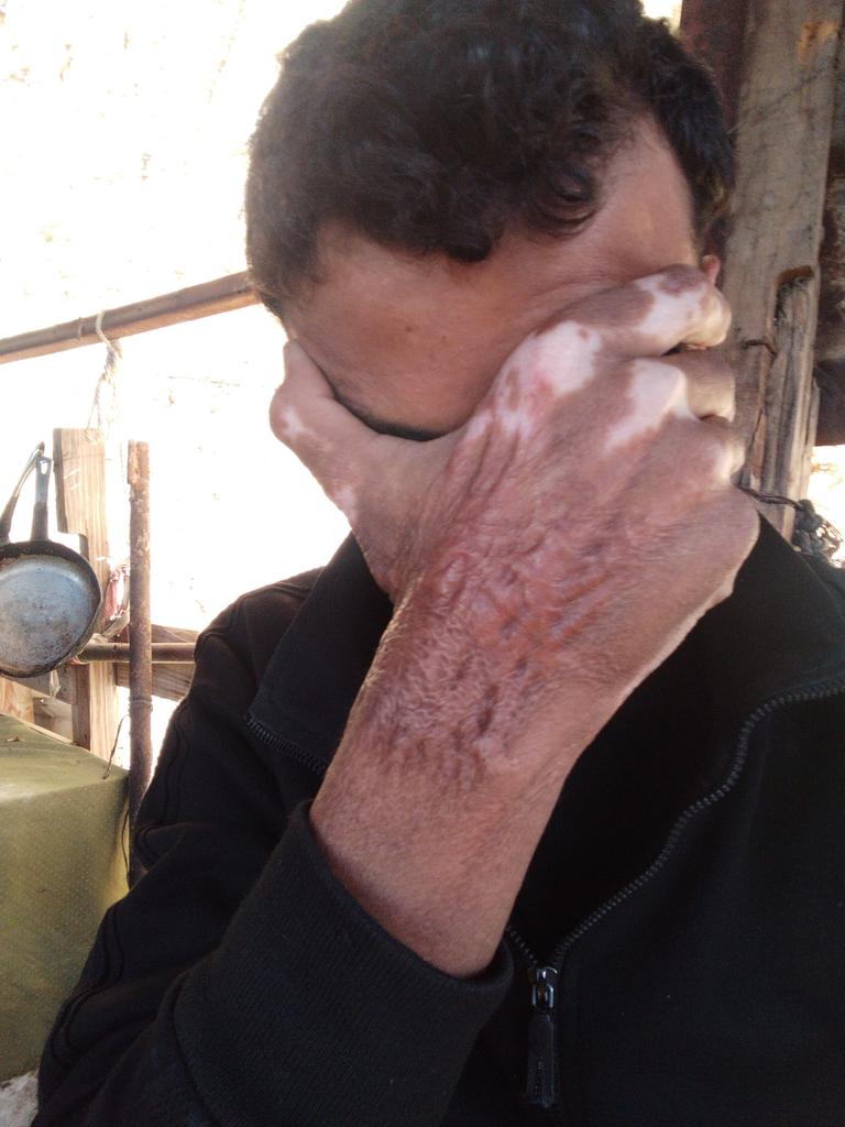 Hamza is a burns victim from Gaza and the burn scars are hurting him psychologically 💔

Donate here: gofundme.com/f/donate-to-sa…

For <a href="/BahaaEdani/">Hamza from Gaza 🇵🇸🍉</a>
He needs surgery to improve the appearance of his burn scars.