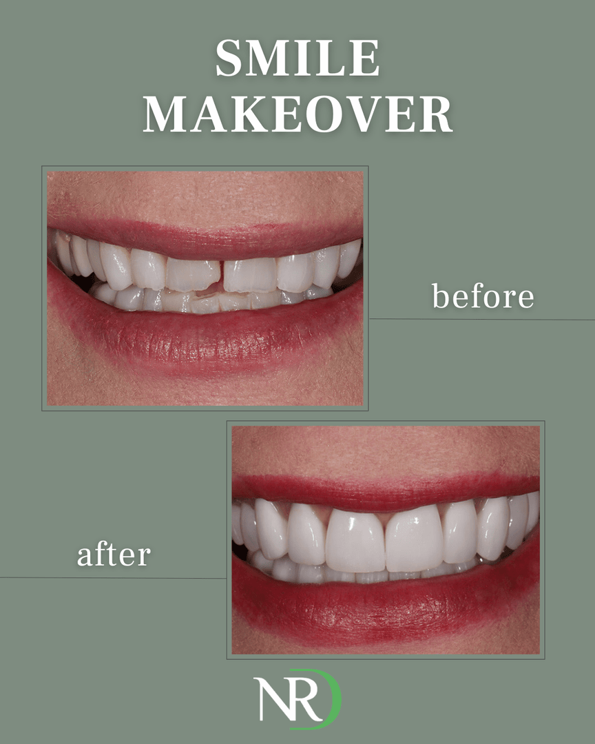 nashrestore's tweet photo. What is a smile makeover? 👉 It’s more than just teeth. It’s a personalized plan to transform your smile with confidence and intention.

Using a blend of cosmetic treatments like whitening, veneers, clear aligners... we design every makeover around you. https://t.co/XIpxrsLPC9
