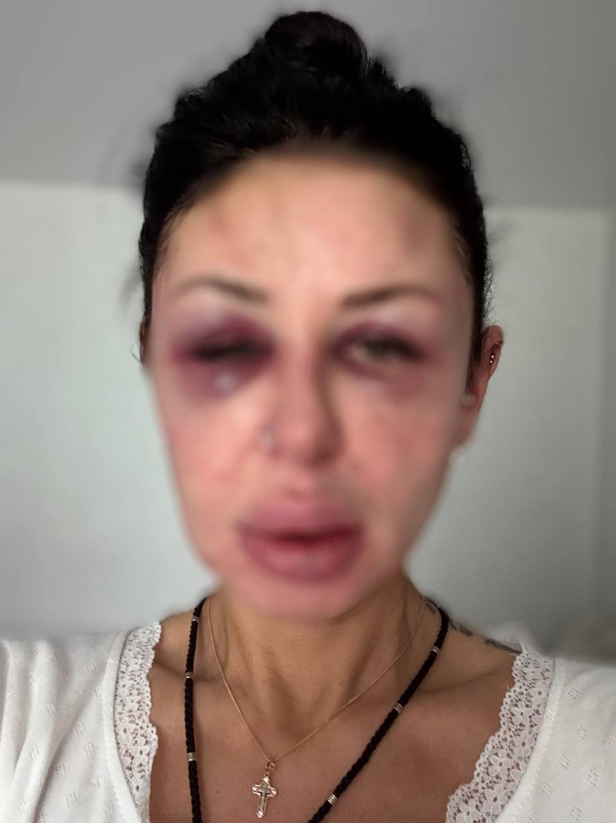 T4acoNBXIw5seBU's tweet image. В Новокузнецке дикарь жестоко избил девушку и теперь угрожает убить её 🤬
Сообщают, что некий Зафарджон Негматов Кишваршоевич целенаправленно преследует девушку. После того как она ответила твердым отказом на предложение общаться, абубандит перешел от угроз к действиям — он…