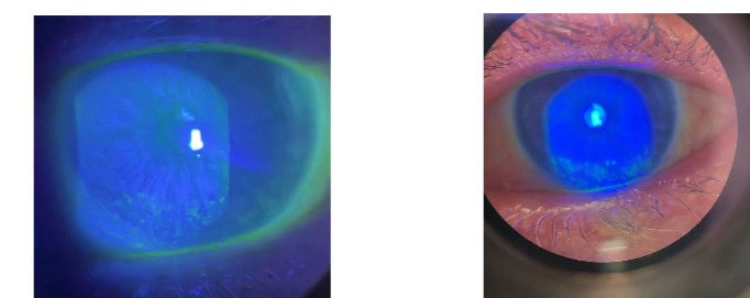 Just finished a video case presentation for one of the journals on a patient with systemic inflammatory disease and dry eye.  I discuss treatment protocols and her case specifically. Stay tuned.