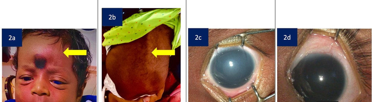 AAOjournal's tweet image. Phacomatosis Pigmentovascularis and Sturge-Weber Syndrome: Comparative outcomes of Primary Combined Trabeculotomy with Trabeculectomy.
ow.ly/juhg50XHrni
#ophthalmology #glaucoma