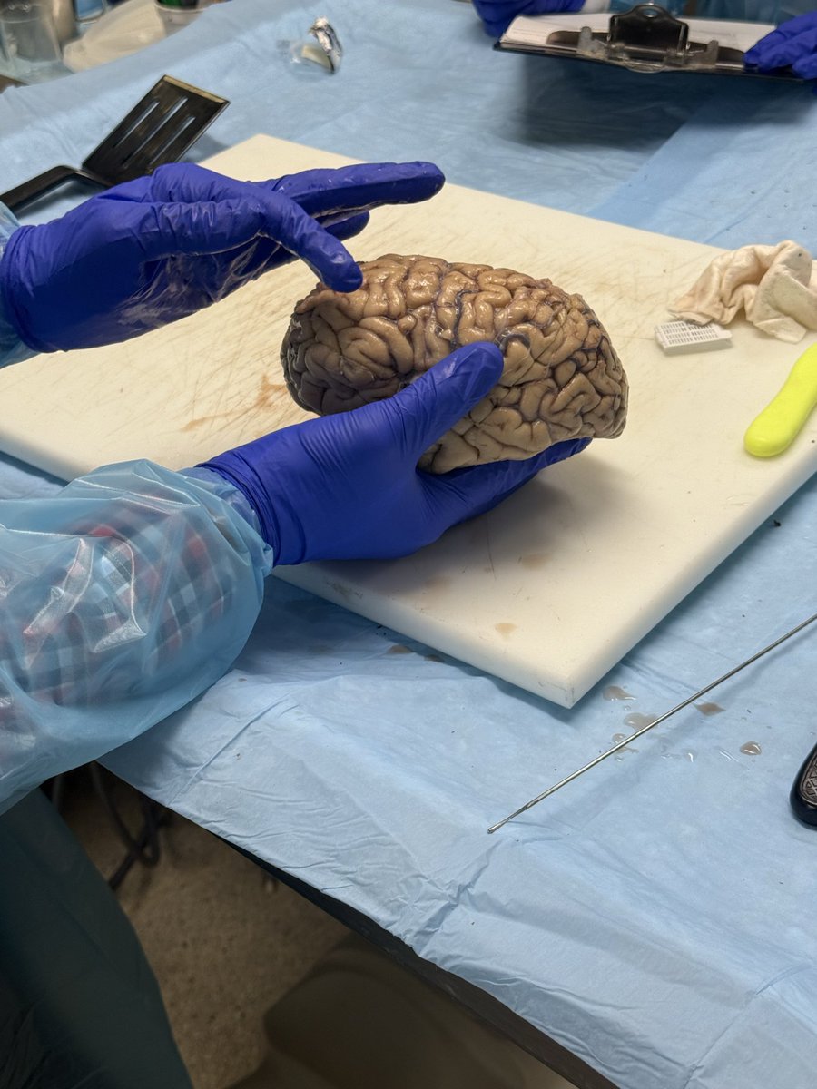zainandthebrain's tweet photo. Thank you to @Rush_Pathology for allowing our fellows to observe a dissection of a brain with a stroke. Pointing out anatomical structures and stroke pathological changes definitely gives us a new perspective on how to think about stroke pathophysiology and care for our patients https://t.co/jzk3cenLK0