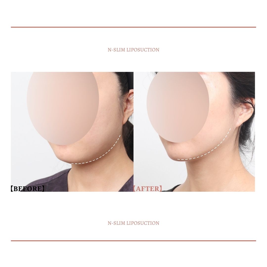 確かな効果を実感！Nスリムの顔脂肪吸引💕
①手術時間:30分  
②麻酔:睡眠麻酔　 
③通院治療:なし
④日常生活:翌日から可能

☘️お問い合わせ
(日本語対応可能)
📲82-10-6771-4500
LINE ID : @nslim

💓日本語通訳が常駐しています🥰
診療時間内に対応します。

☘️診療時間案内
火曜日~金曜日