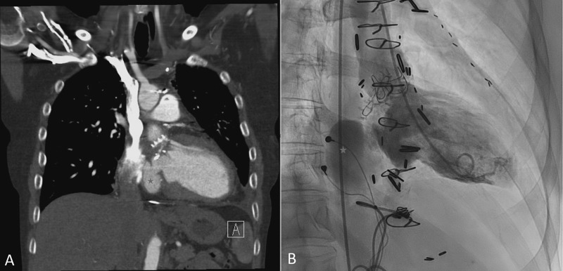 CRMjournal's tweet image. Congratulations to the top case of December 2025 in
CRM: Interesting Cases!

Percutaneous closure of a left ventricular #PSA using a post-infarct #VSD Device guided by #ICE

Check out the brief interview of first author Omar Jafar by @GiorgioMedranda!

crtonline.org/video-detail/p…