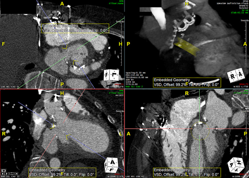 CRMjournal's tweet image. Congratulations to the top case of December 2025 in
CRM: Interesting Cases!

Percutaneous closure of a left ventricular #PSA using a post-infarct #VSD Device guided by #ICE

Check out the brief interview of first author Omar Jafar by @GiorgioMedranda!

crtonline.org/video-detail/p…