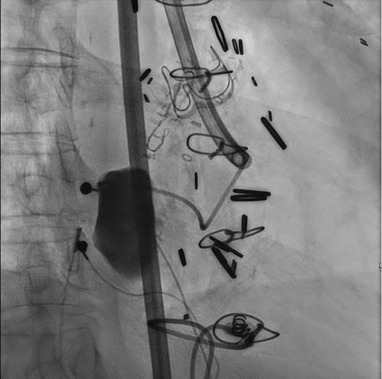 CRMjournal's tweet image. Congratulations to the top case of December 2025 in
CRM: Interesting Cases!

Percutaneous closure of a left ventricular #PSA using a post-infarct #VSD Device guided by #ICE

Check out the brief interview of first author Omar Jafar by @GiorgioMedranda!

crtonline.org/video-detail/p…